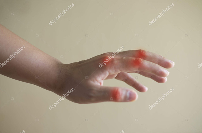 Ways to Live better with Arthritis